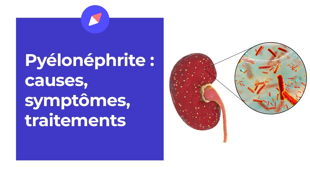 Pyélonéphrite : causes, symptômes, traitement