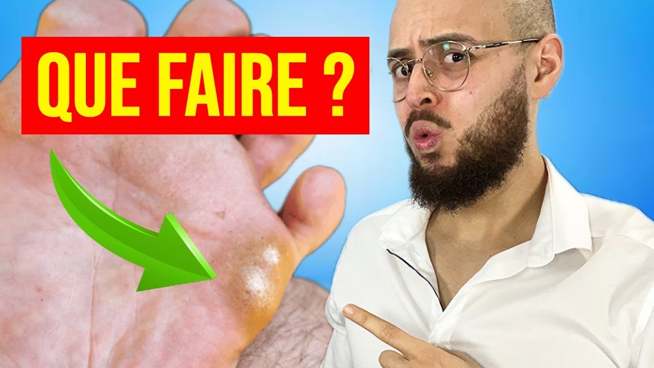 Comment soigner un Cor au pied ? SOLUTION MAISON
