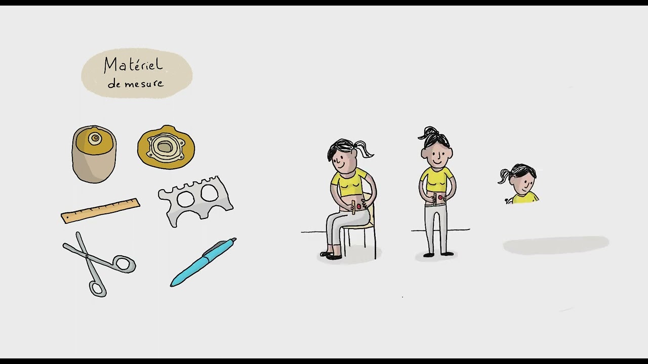 Comment nettoyer une stomie ?