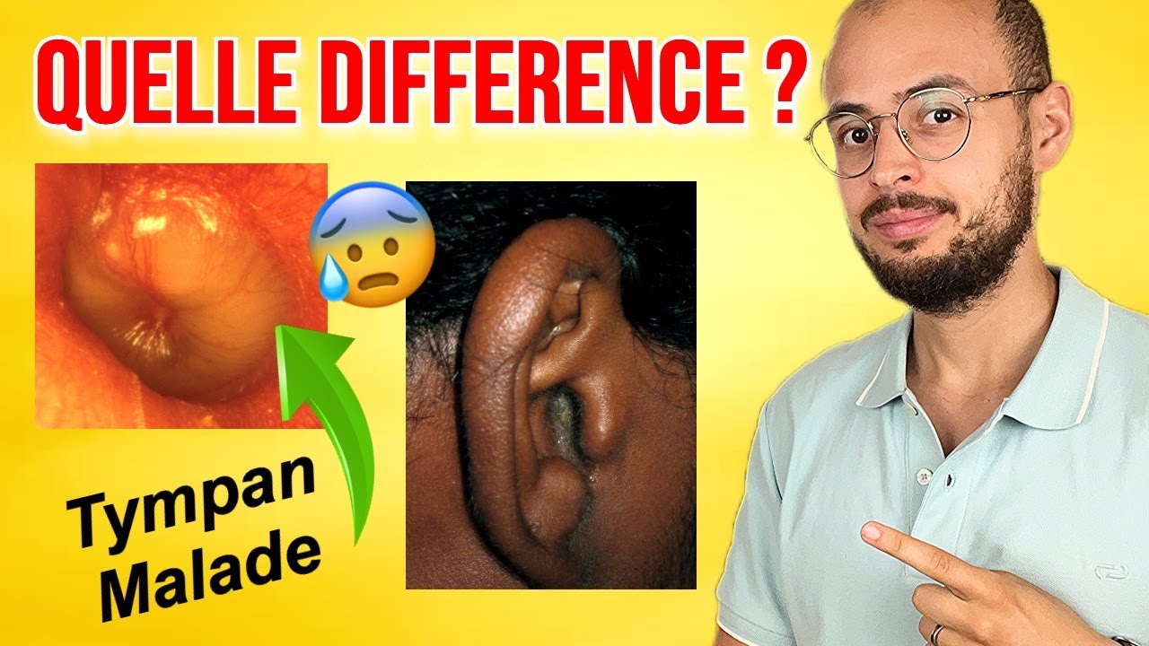 Douleur de l'OREILLE : Otite EXTERNE ou MOYENNE ? Comment faire la différence ?