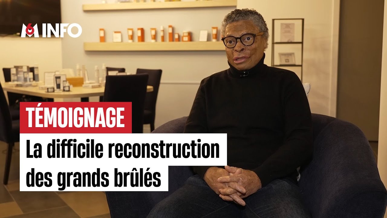 La difficile reconstruction des grands brûlés