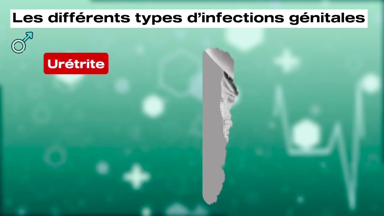 Infections Urinaires et Génitales : Causes, Symptômes et Solution Naturelle Efficace !