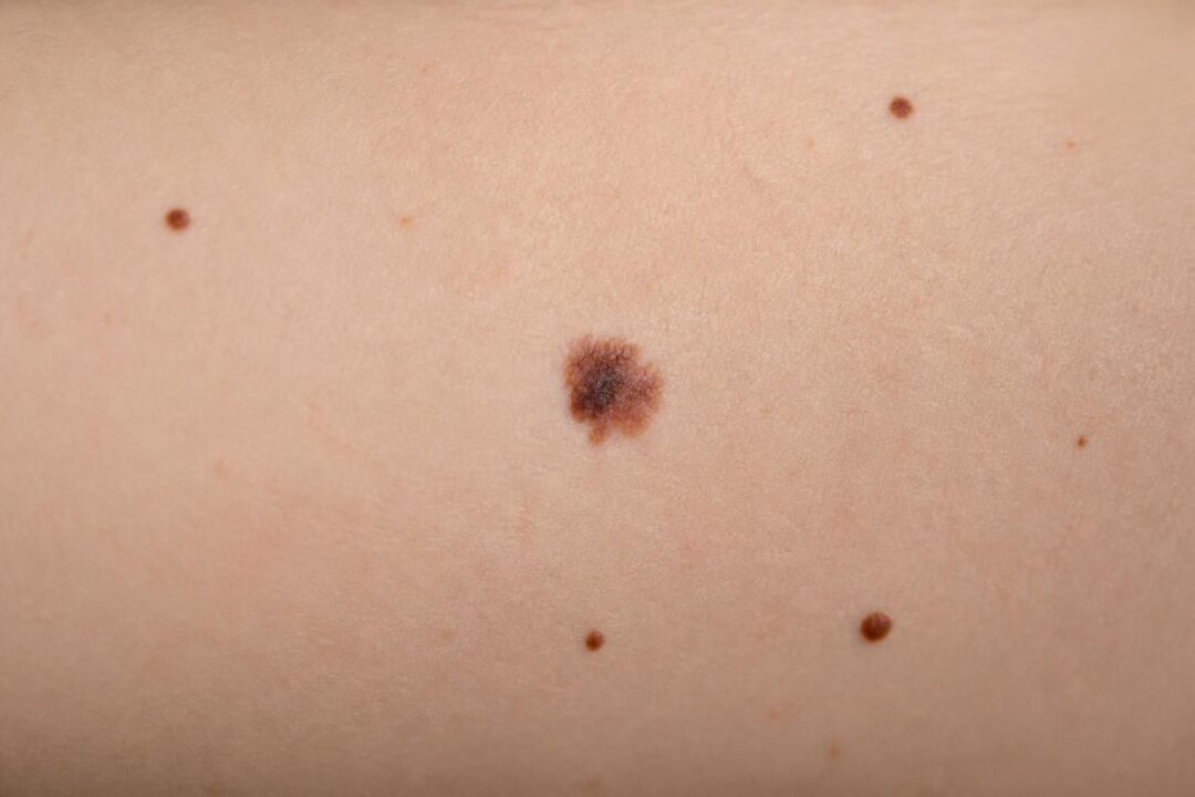 découvrez les signes d'un grain de beauté suspect et apprenez quand il est essentiel de consulter un dermatologue pour prévenir tout risque.