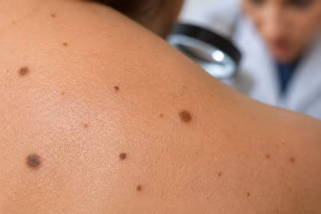 découvrez pourquoi il est essentiel de surveiller de près vos grains de beauté pour détecter rapidement tout changement suspect et prévenir les risques pour votre santé.