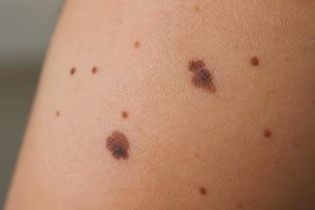 découvrez quand un grain de beauté doit vous alerter et les signes à surveiller pour prévenir les risques de cancer de la peau.