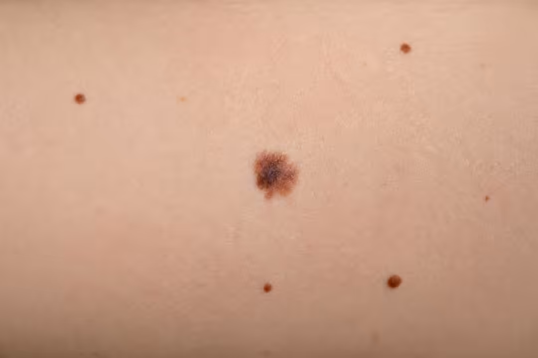 découvrez les signes d'un grain de beauté suspect et apprenez quand il est essentiel de consulter un dermatologue pour prévenir tout risque.