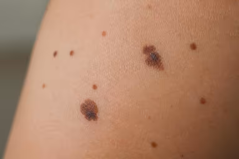 Grain de beauté : à partir de quand faut-il s&rsquo;inquiéter ?